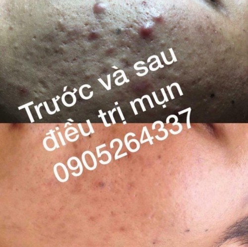 7 spa trị mụn hiệu quả nhất tam kỳ, quảng nam