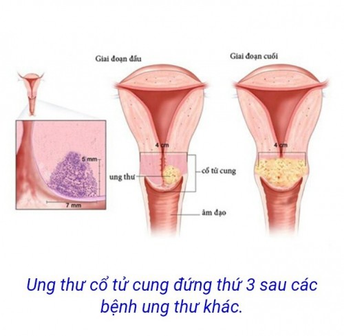 12 bệnh ung thư thường gặp ở phụ nữ và cách phòng tránh