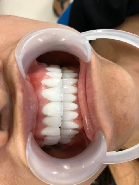 7 Địa chỉ bọc răng sứ thẩm mỹ tốt nhất tại quận 8, TP HCM