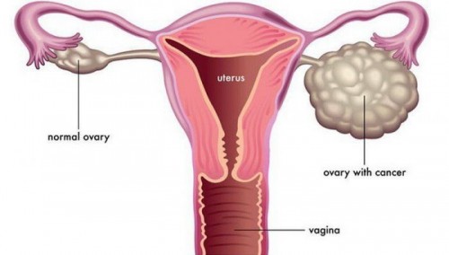 4 điều cần biết về ung thư buồng trứng giai đoạn 3