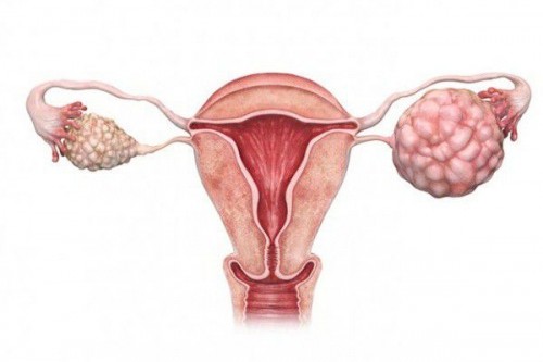 4 điều cần biết về ung thư buồng trứng giai đoạn 3