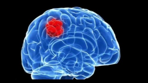 8 điều cần biết nhất về căn bệnh u não
