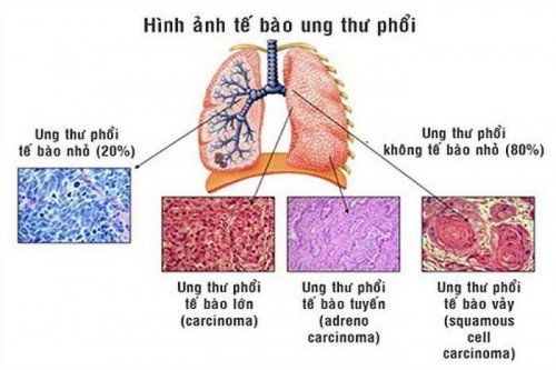 8 điều cần biết về căn bệnh ung thư phổi