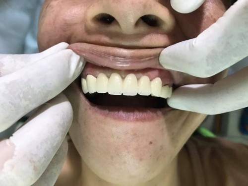 5 địa chỉ bọc răng sứ uy tín nhất phú yên
