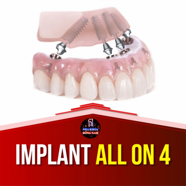 15 địa chỉ trồng răng implant tốt nhất tại tp hcm
