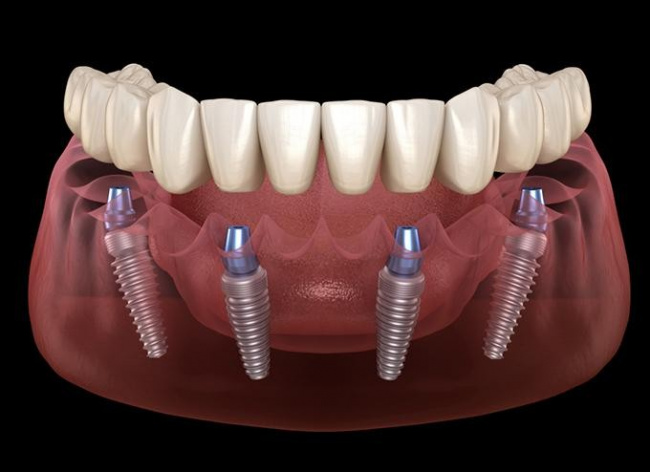 10 địa chỉ trồng răng implant uy tín nhất quận đống đa, hà nội