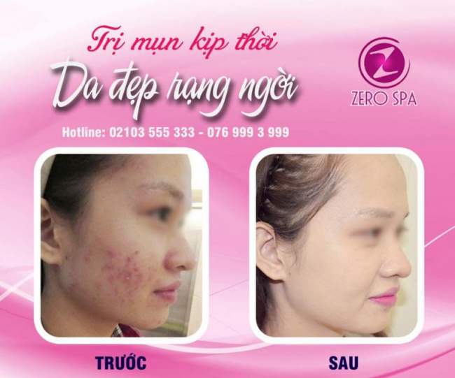 7 spa trị mụn hiệu quả nhất ở việt trì, phú thọ