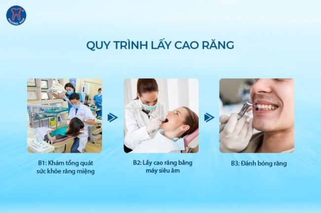 10 Địa chỉ lấy cao răng an toàn và uy tín nhất ở Hà Nội