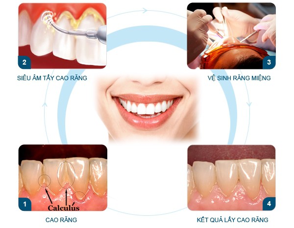 10 địa chỉ lấy cao răng an toàn, uy tín nhất Hà Nội