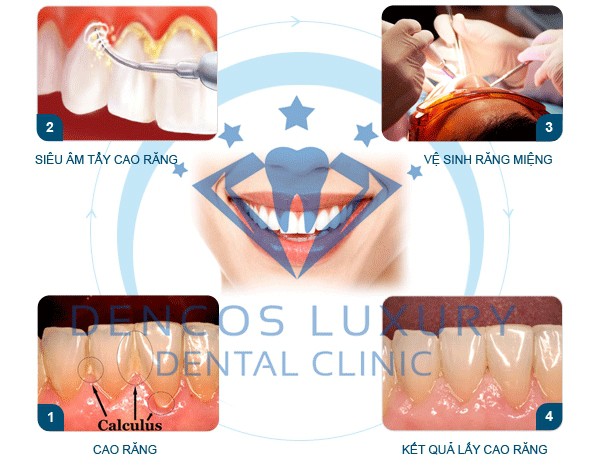 10 địa chỉ lấy cao răng an toàn và uy tín nhất ở hà nội