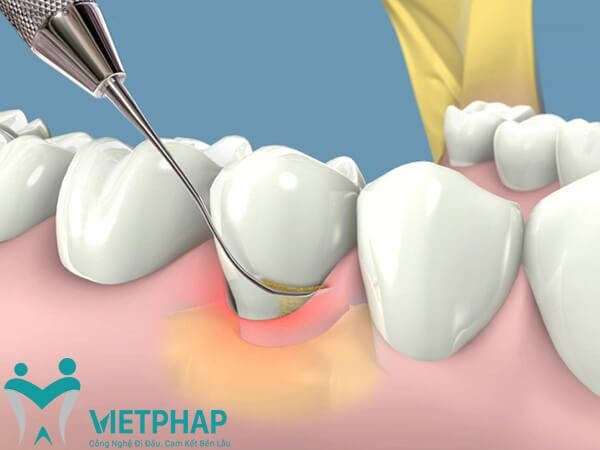 10 địa chỉ lấy cao răng an toàn và uy tín nhất ở hà nội