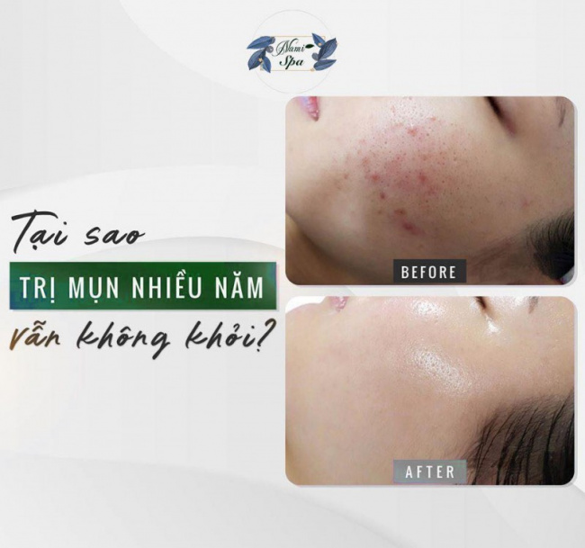 10 spa trị mụn hiệu quả nhất ở Hải Phòng