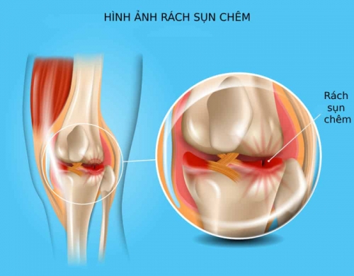 8 chấn thương thường gặp khi đá bóng