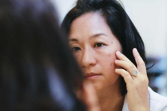 blog, [review] vì sao bị nám da mặt? cách chữa nám da mặt nào hiệu quả nhất?