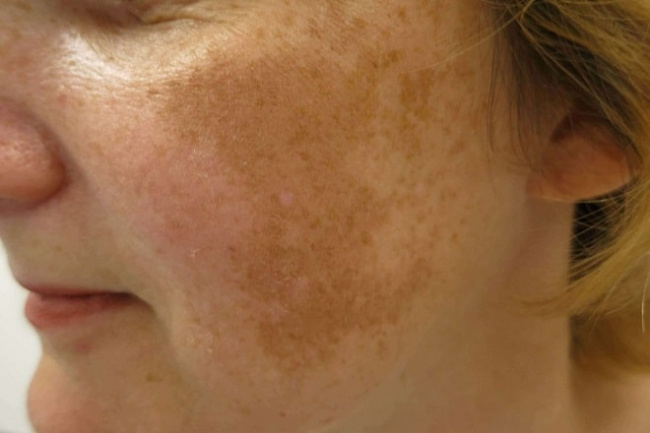 blog, [review] vì sao bị nám da mặt? cách chữa nám da mặt nào hiệu quả nhất?