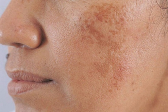 blog, [review] tại sao bị nám da mặt? cải thiện nám da bằng phương pháp nào?