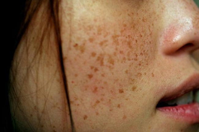 blog, [review] tại sao bị nám da mặt? cải thiện nám da bằng phương pháp nào?
