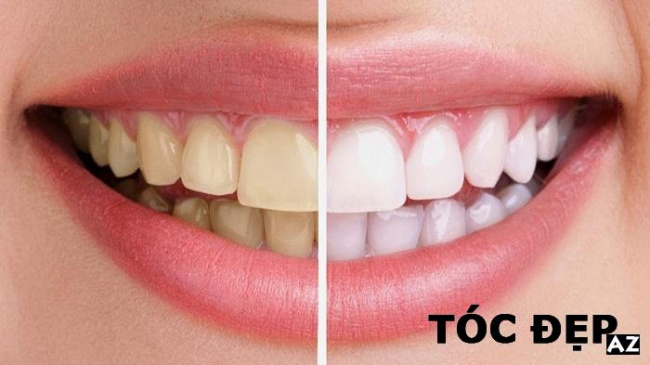 Tẩy trắng răng – Bài viết đầy đủ nhất cho người đang cần răng trắng
