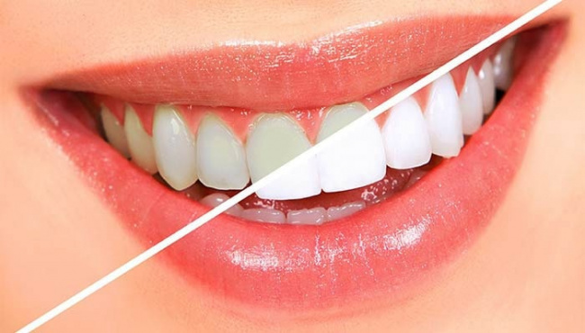 blog, tẩy trắng răng – bài viết đầy đủ nhất cho người đang cần răng trắng