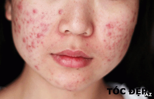 [Review] Vì sao da mặt bị ngứa và sần sùi? Nguyên nhân, cách khắc phục