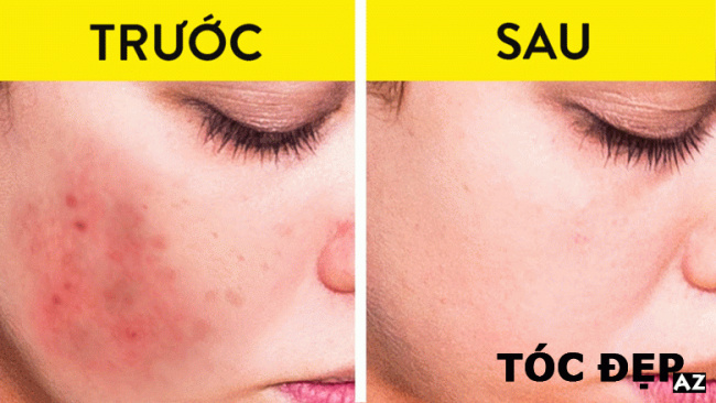 blog, [review] cách chăm sóc da mặt bị mụn đúng khoa học, hiệu quả tức thì