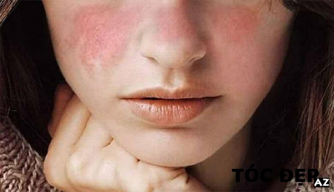 blog, [review] dấu hiệu dị ứng da mặt và những điều cần biết