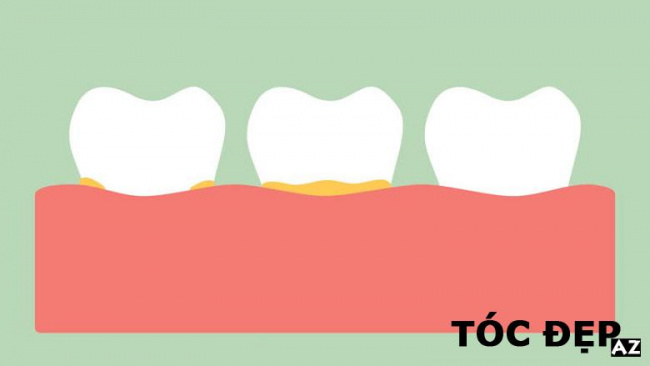 blog, tăng sức quyến rũ với hàm răng sáng bóng nhờ lấy cao răng