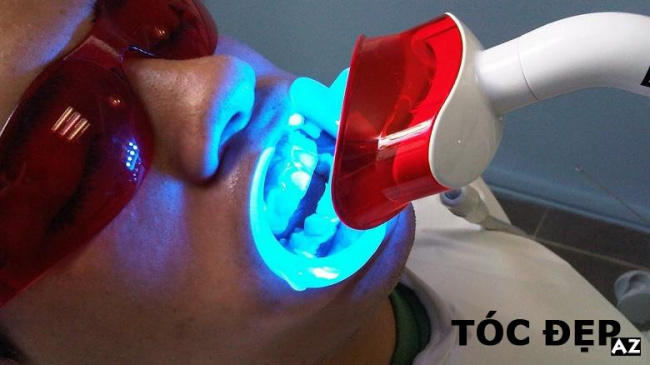 blog, tẩy trắng răng bằng đèn plasma là gì? có hại hay không?
