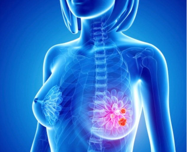 Bạn nên biết những dấu hiệu sớm của bệnh ung thư vú sau đây:
