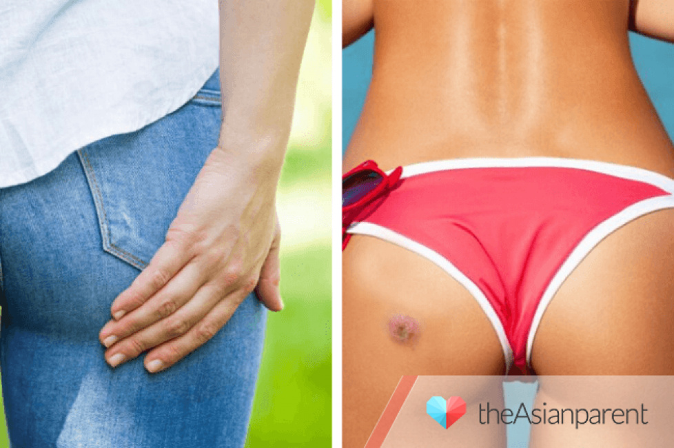9 cách xử lý mụn nhọt ở mông không cần làm bể mụn và quan trọng là không gây đau đớn