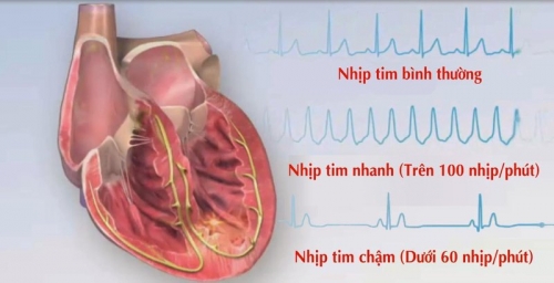 11 Lưu ý quan trọng nhất về rối loạn nhịp tim