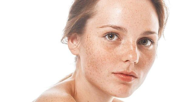 Review top 5 loại kem trị tàn nhang giúp cải thiện cho làn da của bạn
