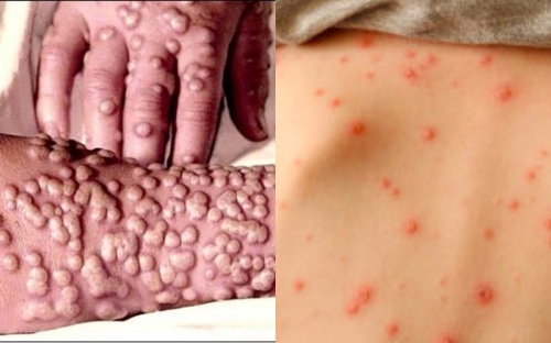 9 lưu ý quan trọng nhất về bệnh đậu mùa