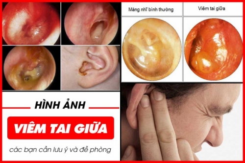 10 lưu ý quan trọng nhất về bệnh viêm tai ngoài