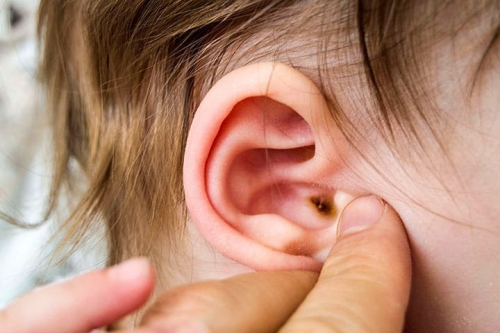 10 lưu ý quan trọng nhất về bệnh viêm tai ngoài