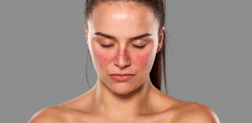 10 lưu ý quan trọng nhất về bệnh lupus ban đỏ