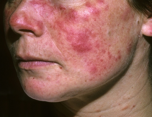 10 lưu ý quan trọng nhất về bệnh lupus ban đỏ