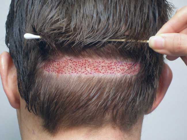 Tìm hiểu về phương pháp cấy tóc trị rụng tóc, hói đầu