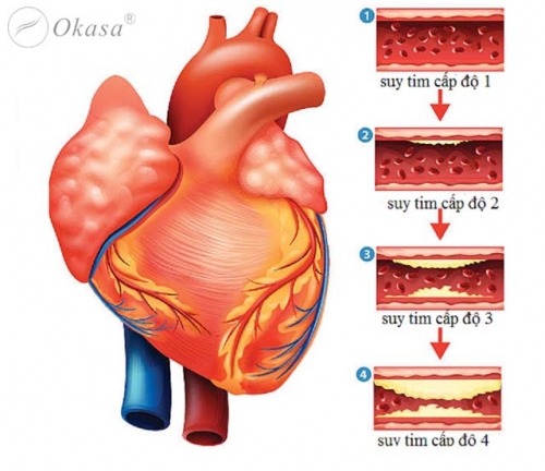 10 lưu ý quan trọng nhất về bệnh suy tim