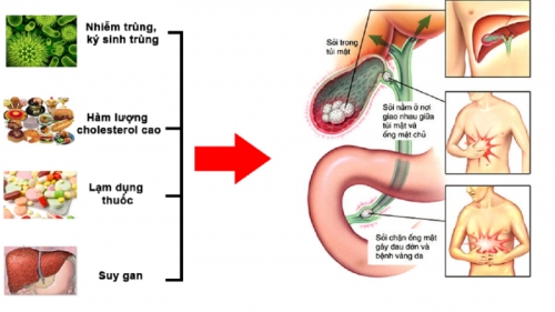 10 lưu ý quan trọng nhất về bệnh polyp túi mật