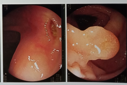 10 lưu ý quan trọng nhất về bệnh polyp túi mật