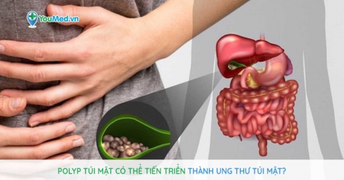 10 lưu ý quan trọng nhất về bệnh polyp túi mật