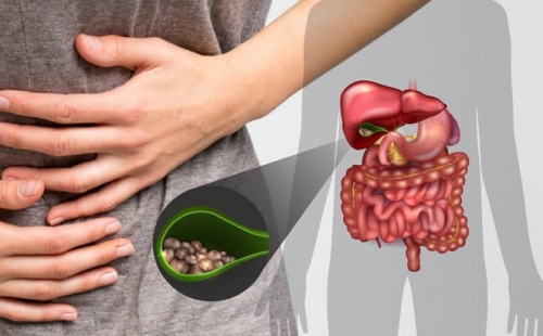 10 lưu ý quan trọng nhất về bệnh polyp túi mật