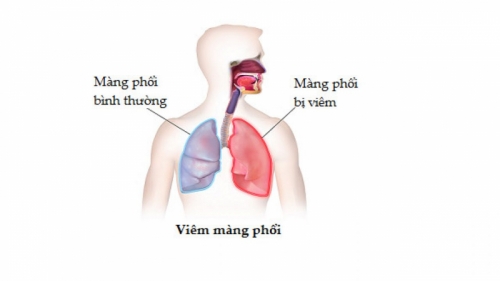 9 Lưu ý quan trọng nhất về bệnh viêm màng phổi