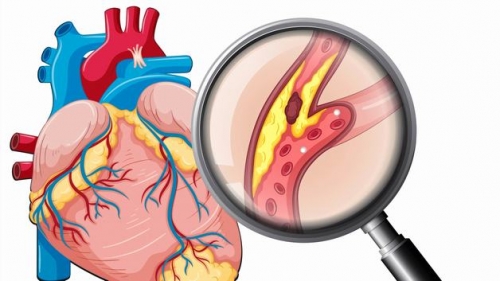 10 lưu ý quan trọng nhất về bệnh mạch vành