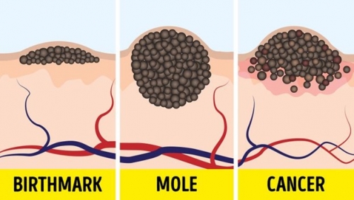 9 lầm tưởng nguy hiểm về nốt ruồi và rám nắng bạn nên biết