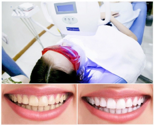 5 nha khoa tẩy trắng răng tốt nhất tại quận hoàn kiếm, hà nội
