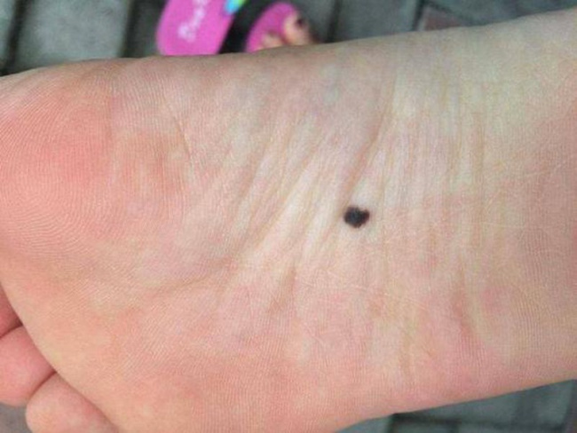 'Nốt ruồi' này trên cơ thể đứa trẻ có nghĩa là 'may mắn'