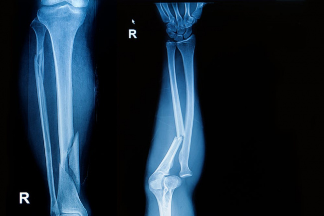 gãy chân: cách điều trị và thực phẩm giúp lành xương nhanh