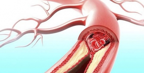 10 bệnh lý tim mạch phổ biến nhất mà bạn nên biết